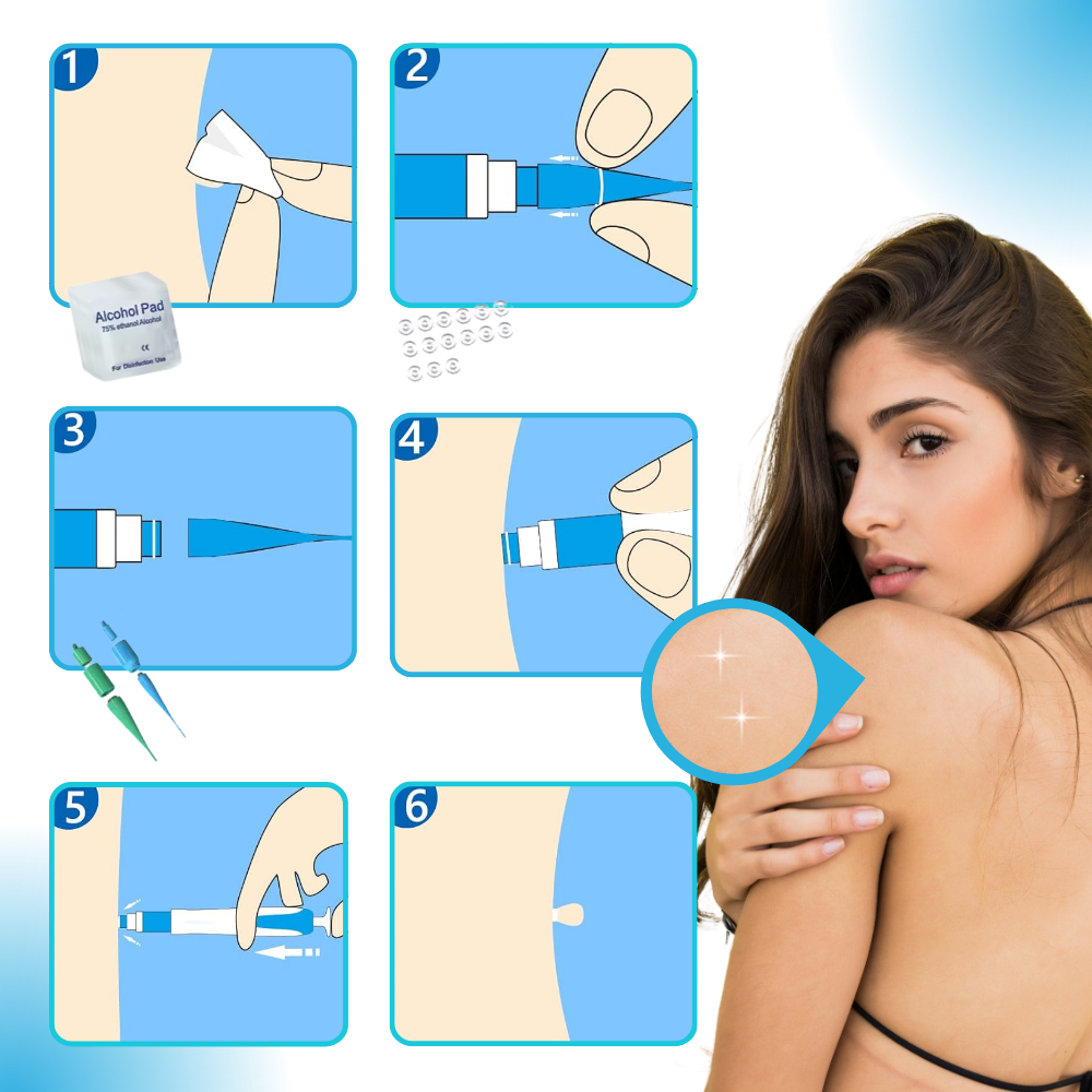 Skin Tag Removal Pro - Ozerty